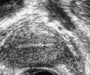 thin uterine lining infertility ivf